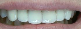 Crowns-and-Bridges-After-Image