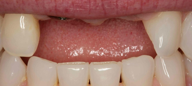 Dental-Implants-Before-Image