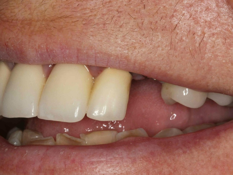 Dental-Implant-Crown-Before-Image
