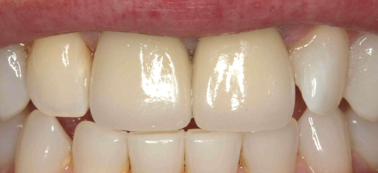 Dental-Implants-After-Image