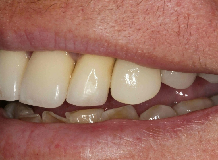 Dental-Implant-Crown-After-Image